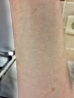 Красные пятна по бокам ступни шелушение
