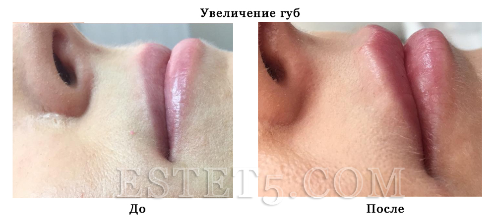 Накачать губы Киев отзывы
