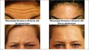 Ботокс лоб Киев