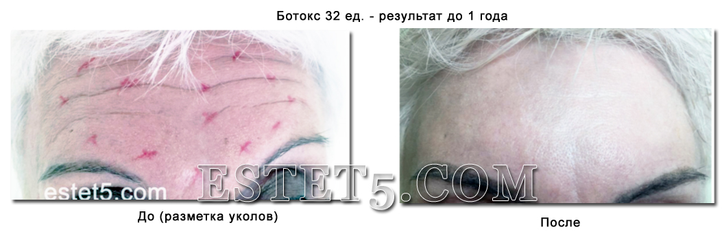 Уколы ботокса