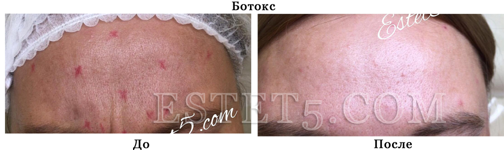 Уколы ботокса