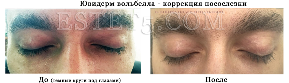 Удалить мешки под глазами цена
