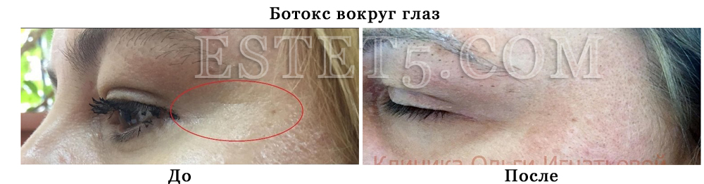 Убрать мешки под глазами операция цена