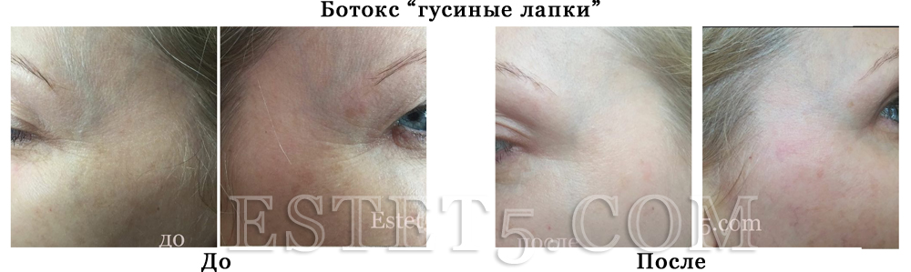 Убрать мешки под глазами цена Киев