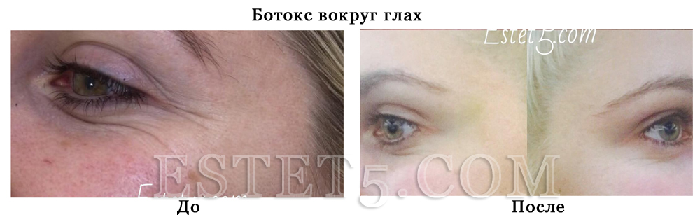 Убрать мешки под глазами операция цена
