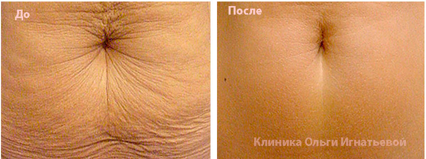 Безинъекционная мезотерапия Киев