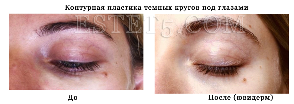 Удалить мешки под глазами цена
