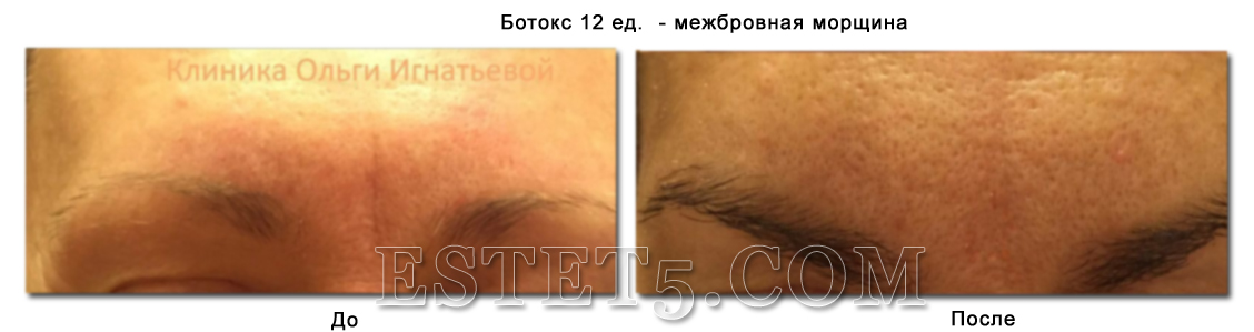 Ботокс в Украине цена