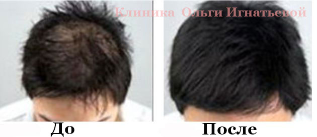 Безинъекционная мезотерапия Киев