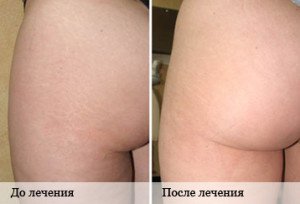 Растяжки