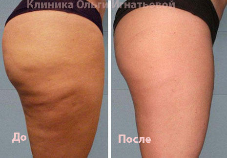 Мезотерапия лица Киев