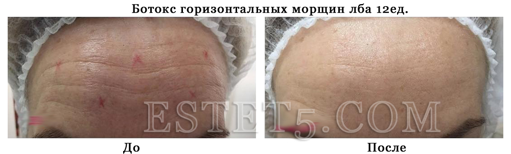 Уколы ботокса