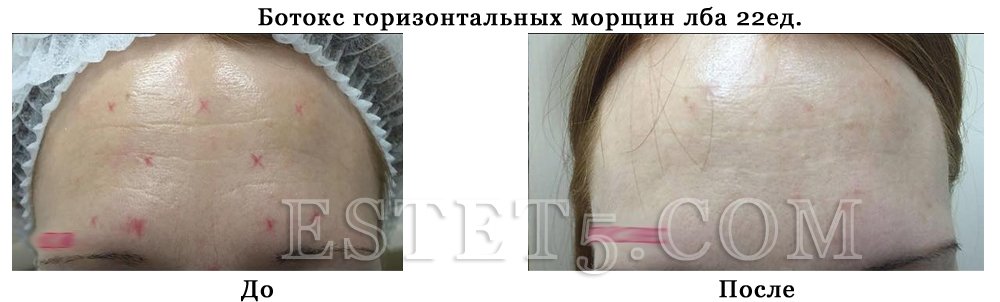 Ботокс в Украине цена