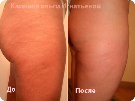 Мезотерапия лица Киев