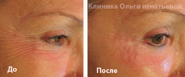 Мезотерапия лица Киев