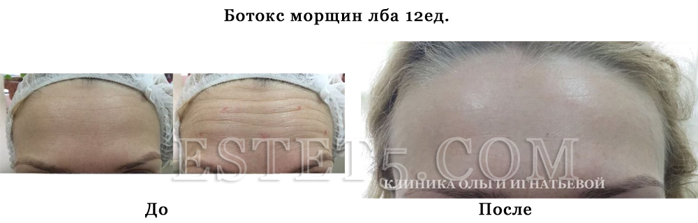 Уколы ботокса