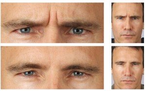 Уколы ботокса