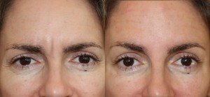 Уколы ботокса