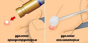 Криотерапия волос Киев