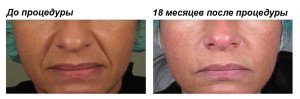 Ботулинотерапия цена Одесса