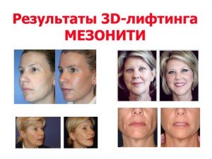 Мезонити цена Киев