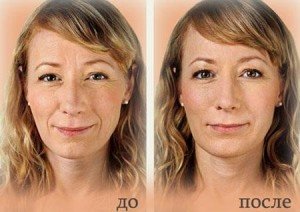 Инъекции рестилайн цены в Киеве